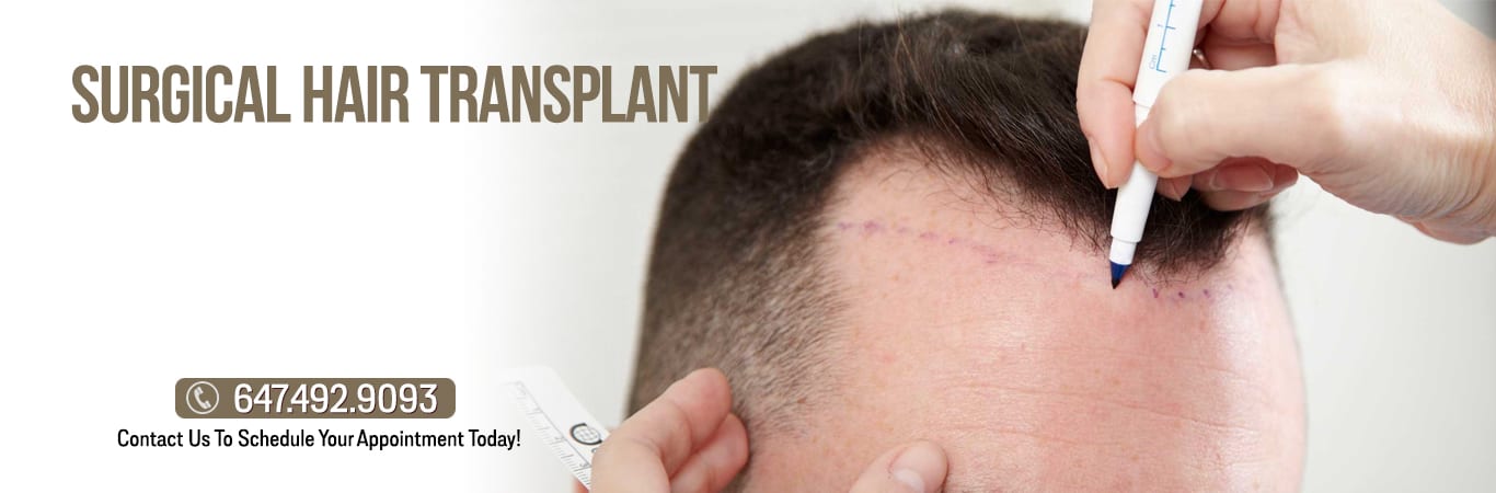 Surgical Hair Transplant | TRICHOLOGY CENTRE | Toronto