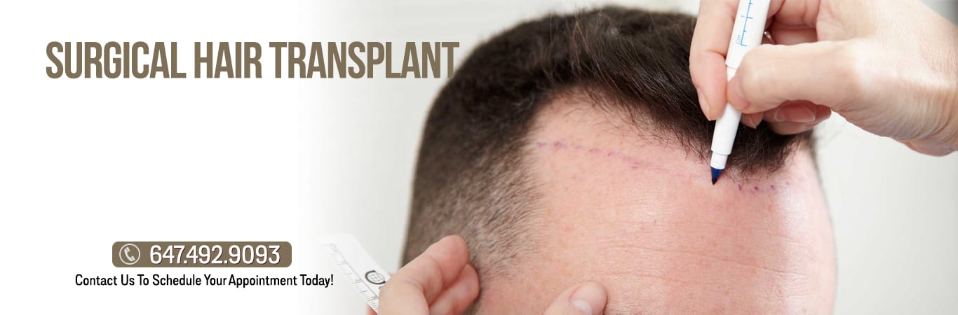 How To Know If You Are An Ideal Candidate For Hair Transplantation