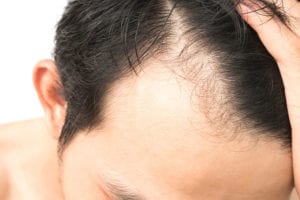 conditions-hair-loss-treatment