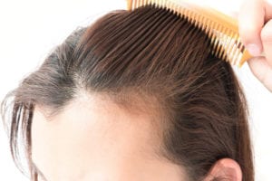 stress hair loss female