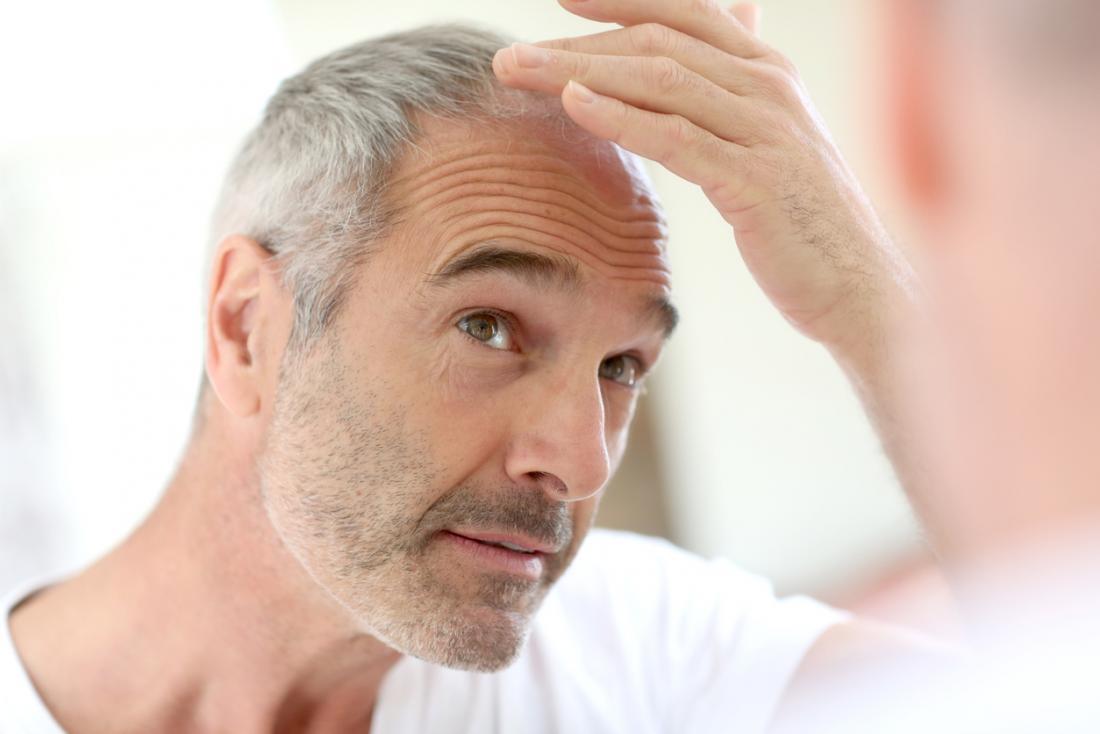 Male Pattern Baldness and Recommended Treatment TRICHOLOGY