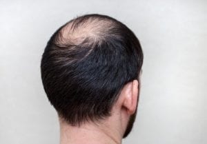 androgenetic alopecia