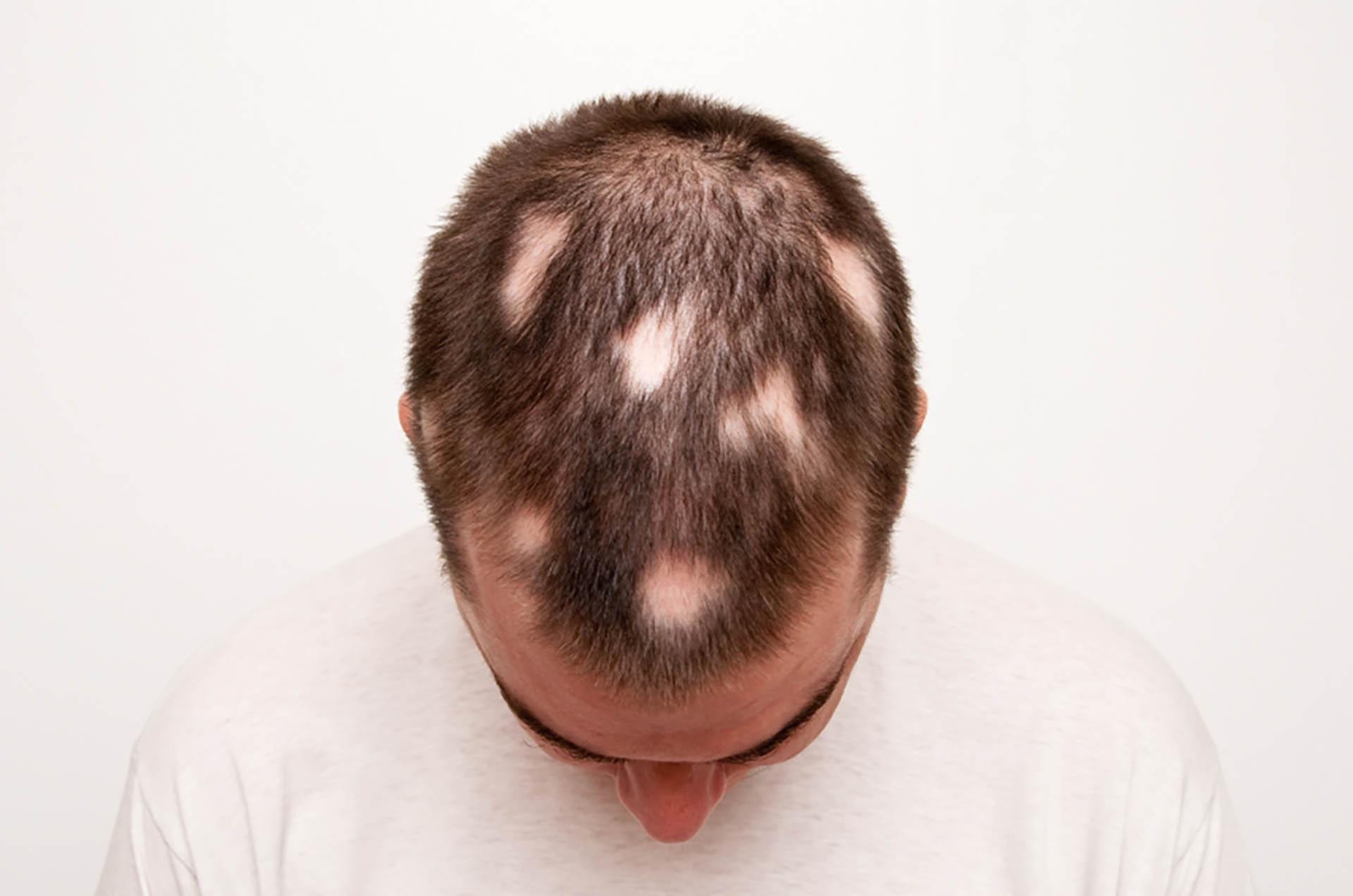 alopecia areata