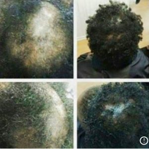 Androgenetic Alopecia Hair Loss Toronto