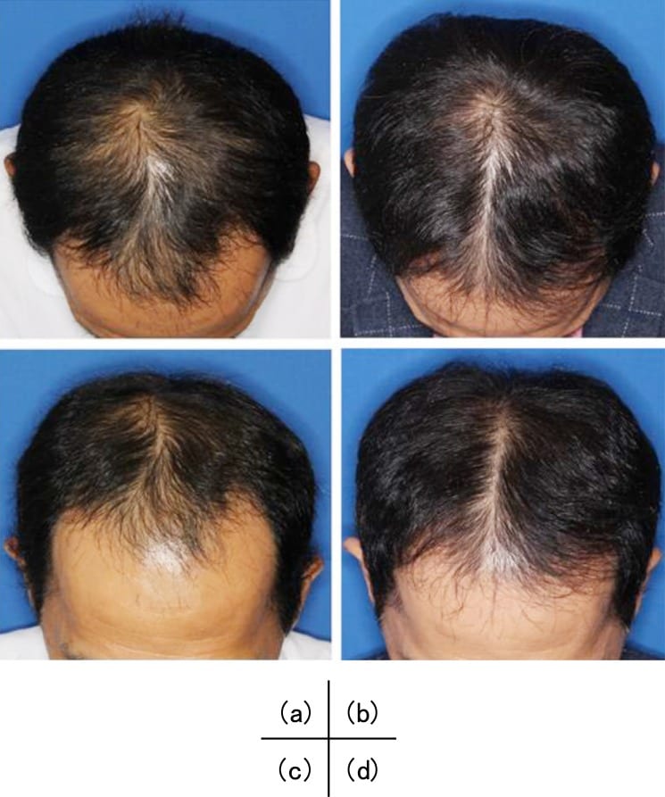 Stem Cell Hair Transplant Service