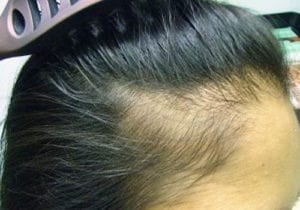 Scalp-Infections-That-Cause-Hair-Loss