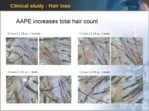 AAPE hair loss treatment