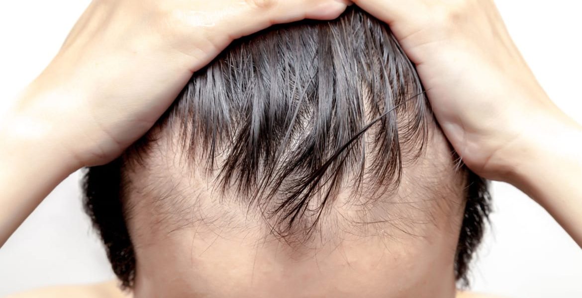 best treatment for hair loss Toronto