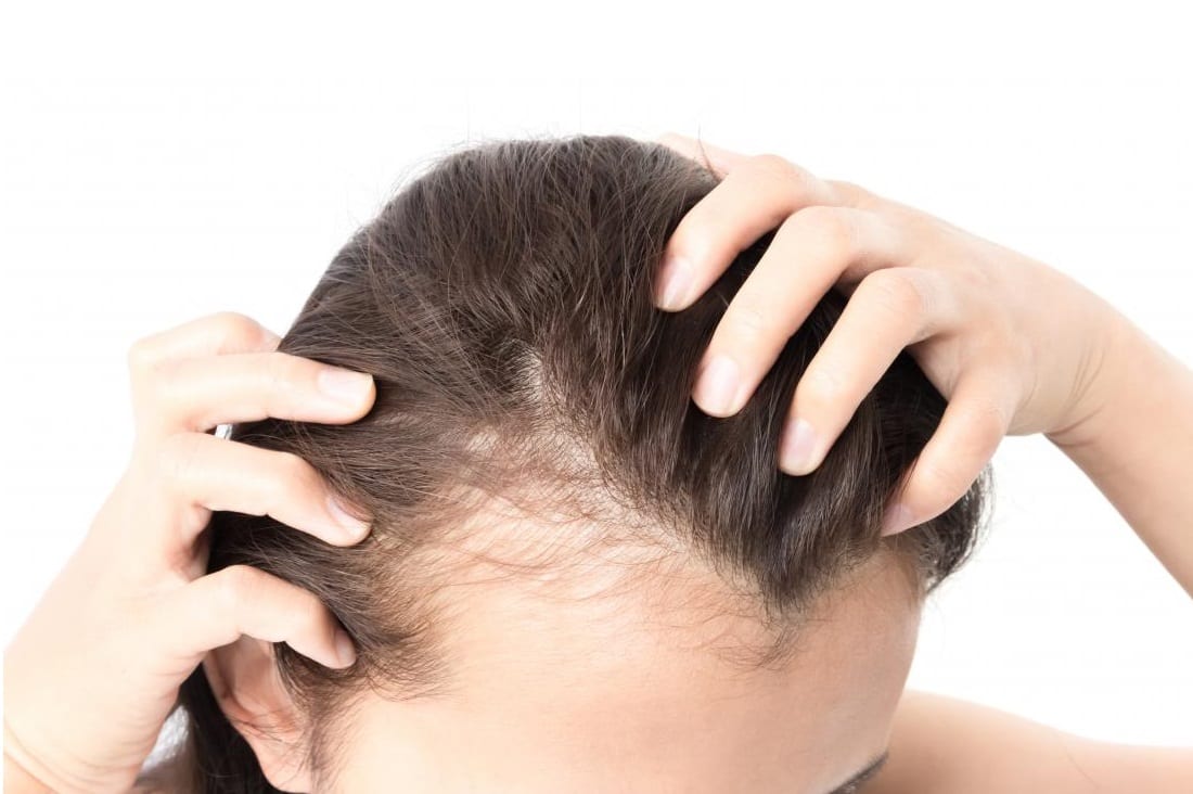 female-pattern-baldness-in-woman-s-scalp 3