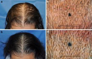 Laser Light Hair Loss Therapy Hair Loss Clinic Toronto