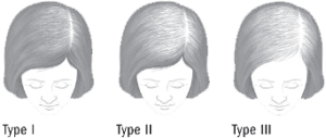 female pattern hair loss