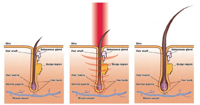 red light laser hair growth