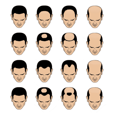 norwood scale