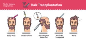 surgical hair transfer
