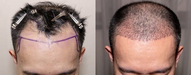 surgical hair transplant 2