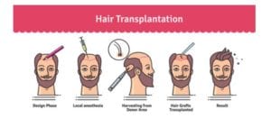 surgical hair transplant