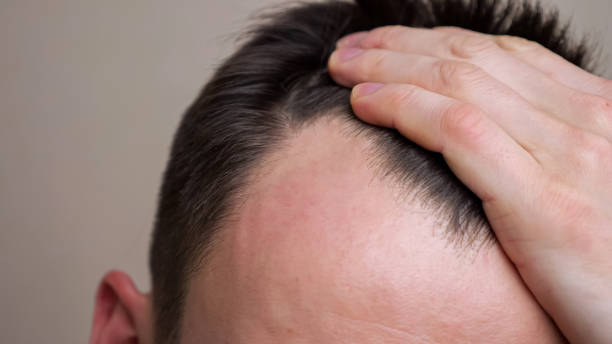 what causes teenage hair loss
