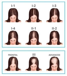 FEMALE PATTERN HAIR LOSS / FEMALE PATTERN HAIR BALDNESS