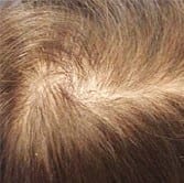 EFFLUVIUM ALOPECIA