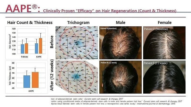 Aape Stem Cell Hair Loss Therapy Trichology Centre Toronto