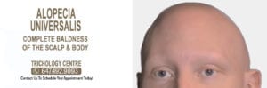 What is Alopecia Universalis?