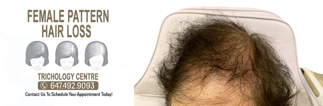 What is Female Pattern Hair Loss? TRICHOLOGY CENTRE