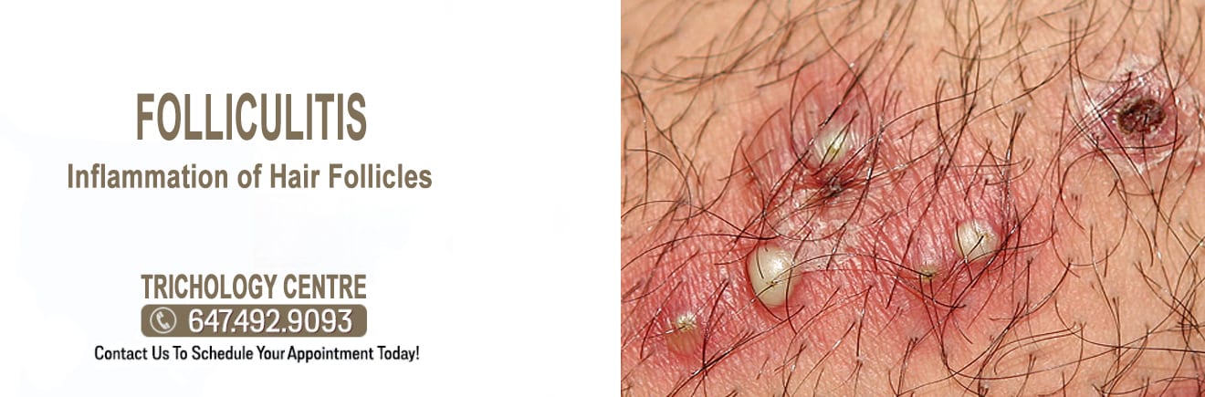 906 Infected Hair Follicle Images Stock Photos  Vectors  Shutterstock