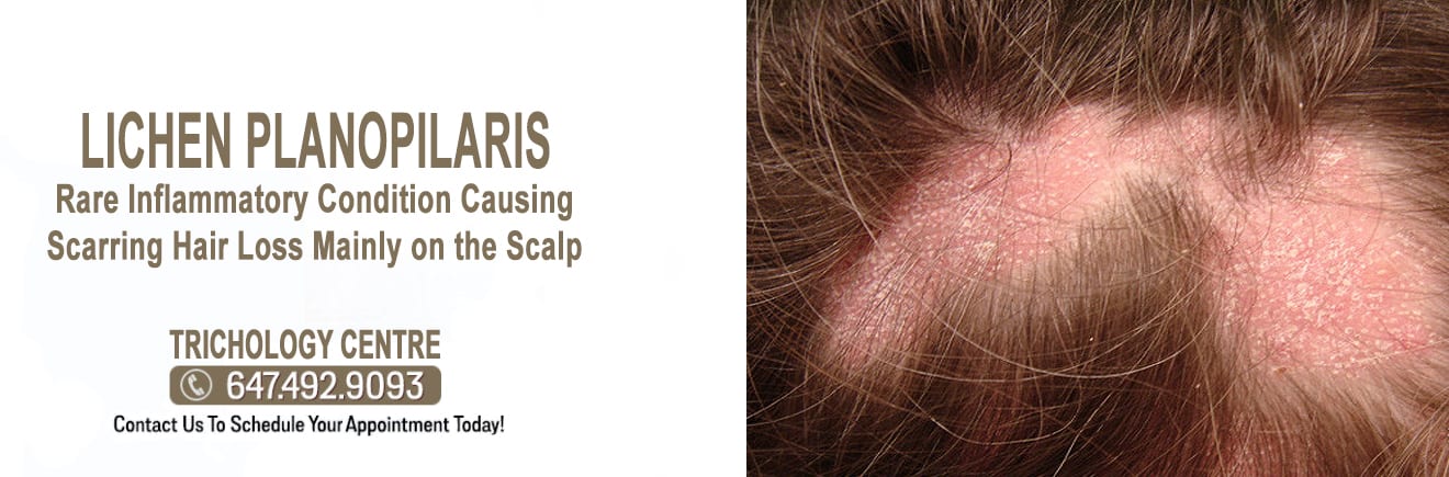 lichen planus scalp