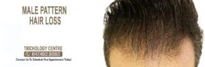 What is Male Pattern Hair Loss?