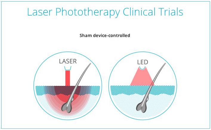 LED VS Laser Hair Growth Treatment Which is Better