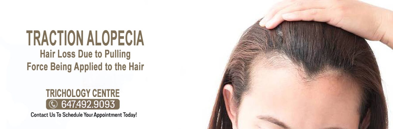 What is Traction Alopecia? TRICHOLOGY CENTRE | Toronto