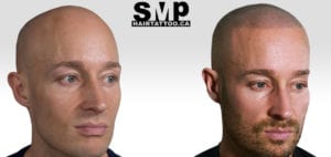 smp before and after photo