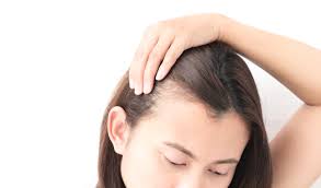 female hair loss treatment 2