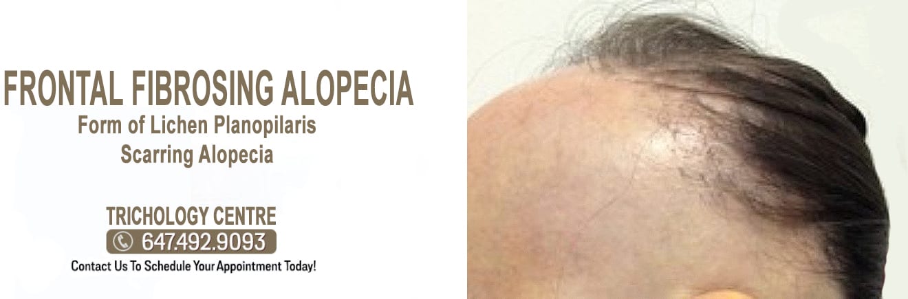 What is Frontal Fibrosing Alopecia?