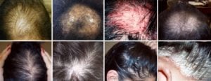 hair loss conditions