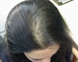 hair loss in women and womens hair loss treatment Toronto