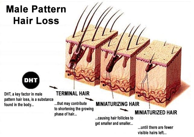 What is Male Pattern Hair Loss TRICHOLOGY CENTRE Toronto