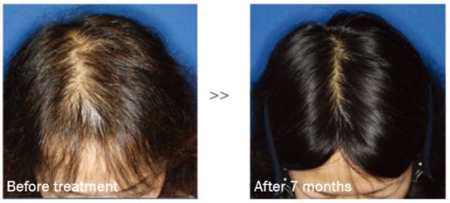AAPE Stem Cells Hair Loss Therapy | TRICHOLOGY CENTRE