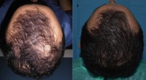 hair loss before and after