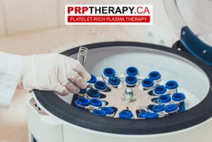 PRP-Therapy-1