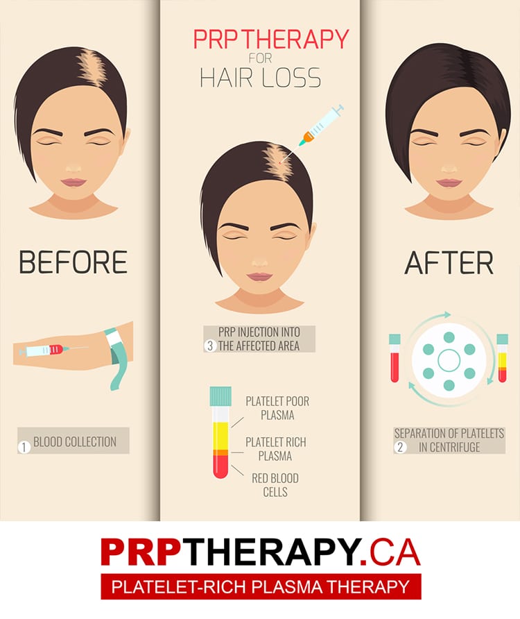 Toronto Hair Loss Treatment With PRP  Promo 599Session