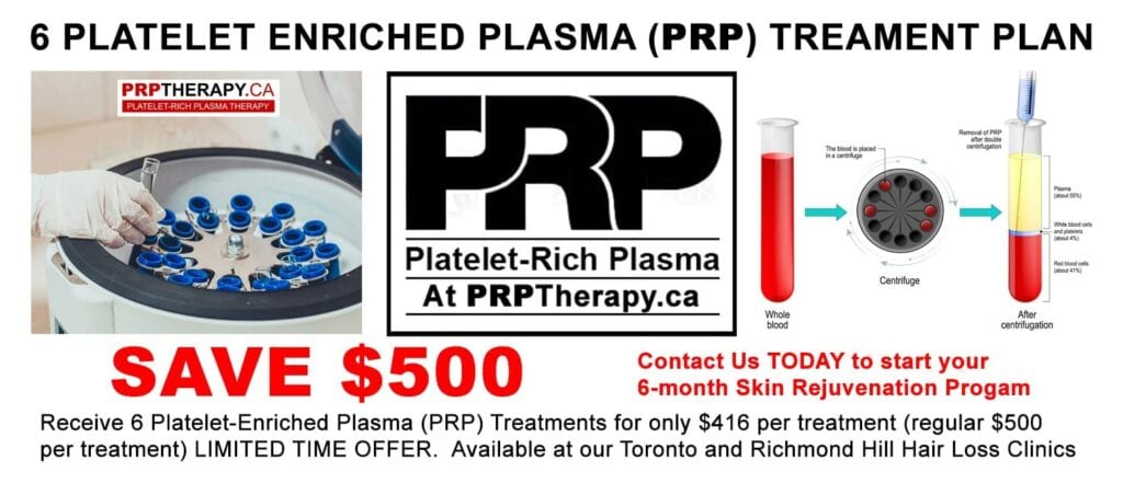 platelet rich plasma PRP treatment Toronto