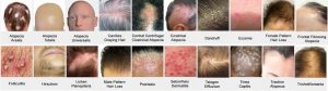 trichology centre Toronto for hair loss