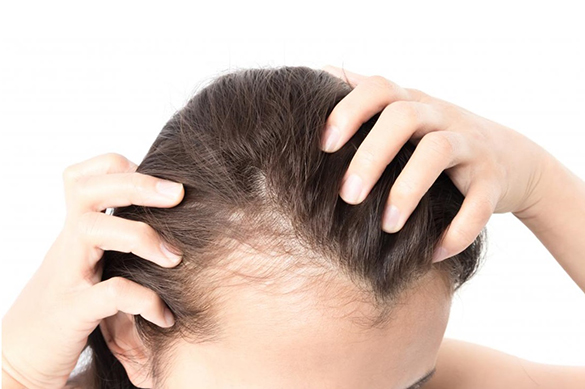 female hair loss treatment Toronto