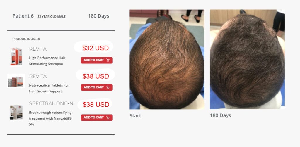 Hair Loss: Sasha Advanced Treatments To Stop Hair Loss and Boost