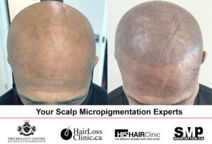 Scalp micdropigmentation - Aquil