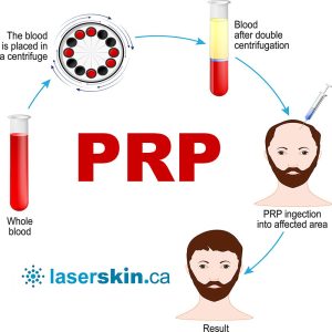 PRP for womens hair loss