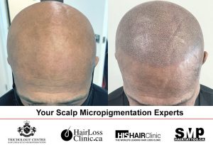 Aquil Scalp Micropigmentation Toronto