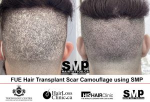 FUE hair transplant scar with scalp micropigmentation Toronto
