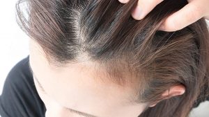 Hair loss women experience - telogen effluvium Toronto